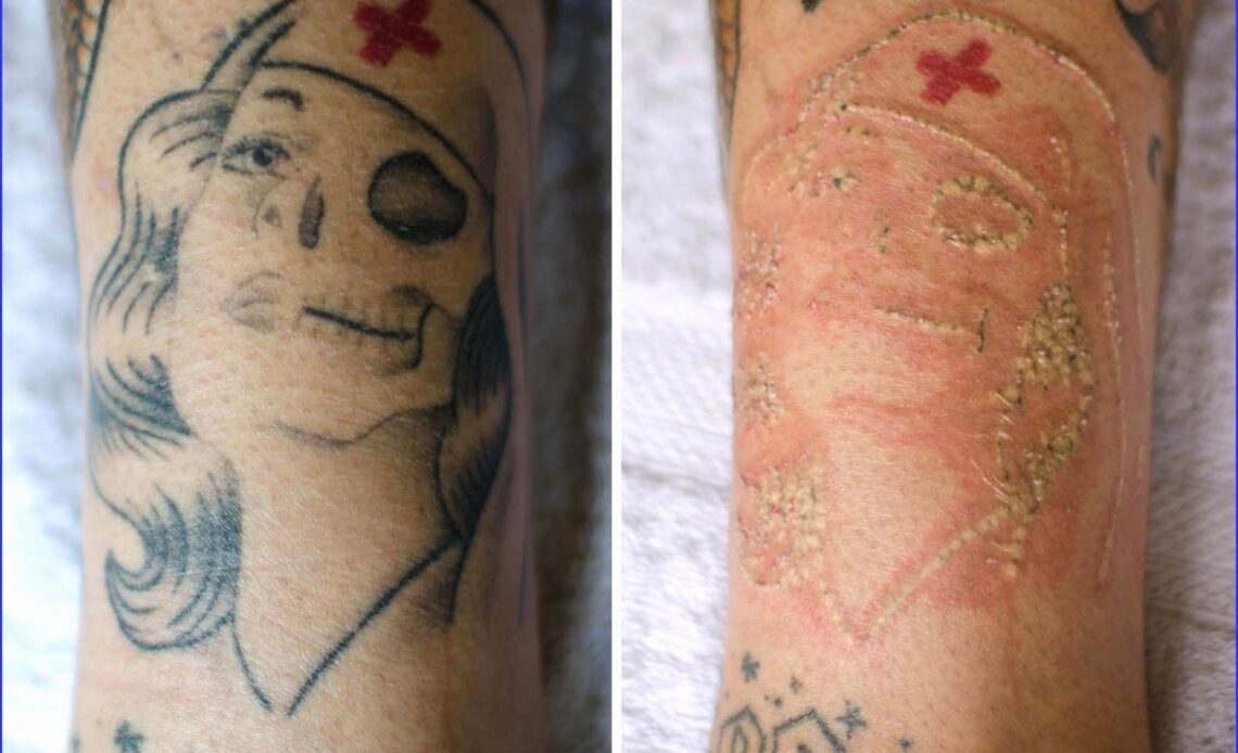 1. Natural Methods for Removing Temporary Tattoos - wide 7