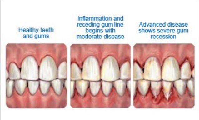 Useful Information For Healthy Teeth and Gums