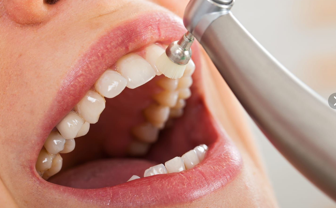 How much is a teeth cleaning without insurance